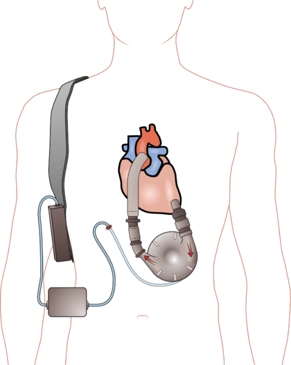420px-Ventricular_assist_device.png